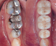 keramikfuellung-zahn-inlay