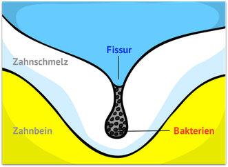 Unerreichbare-Zahntäler-Fissurenversiegelung