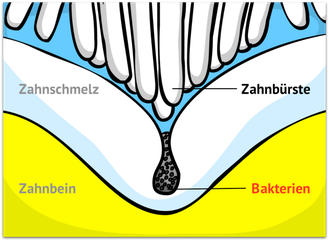 Zahnbürsteborsten-sind-zu-dick-Fissurenversiegelung