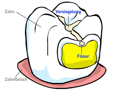 Fissurenversiegelung-an-einem-Backenzahn