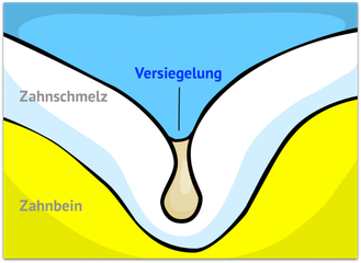 versiegelte-Zahnflächen-schützen-vor-Karies