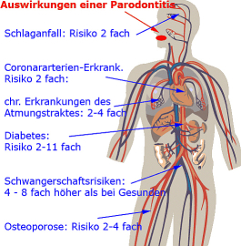 Parodontose Parodontitis - heilt nicht von selber.